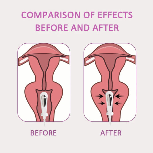 EMS Incontinence Vaginal Pelvic Floor Muscle Stimulator - Complete Kit With Probe