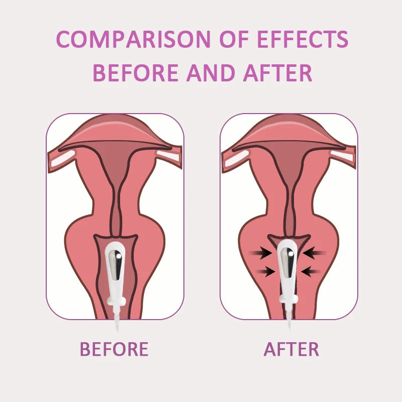 EMS Incontinence Vaginal Pelvic Floor Muscle Stimulator - Complete Kit With Probe